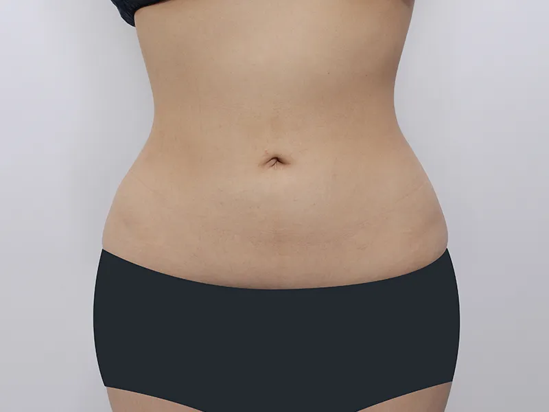 腹部脂肪吸引 術後