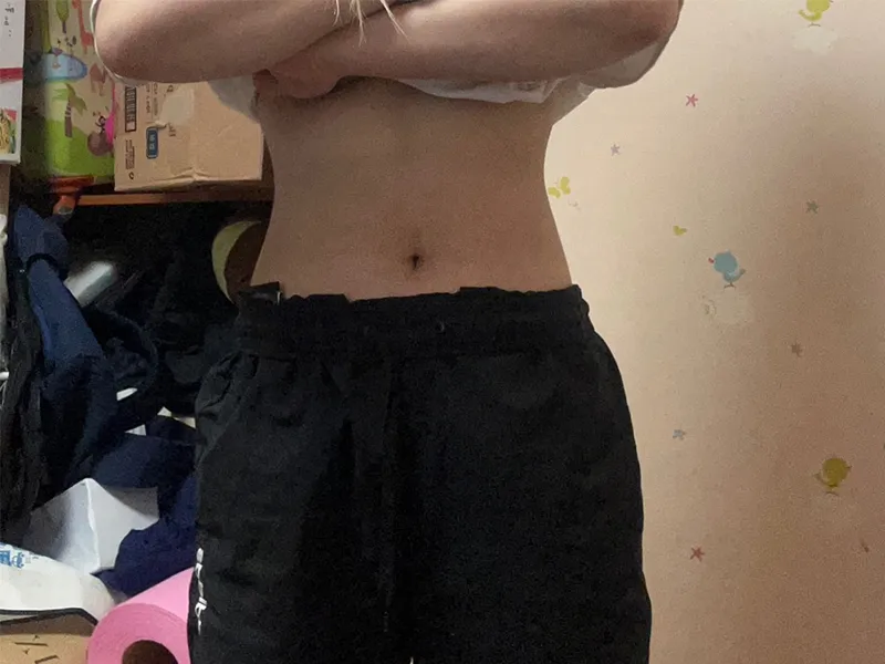 腹部脂肪吸引 術後