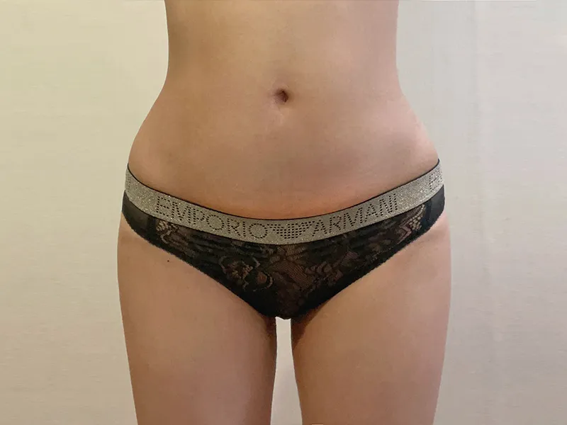 腹部脂肪吸引 術後