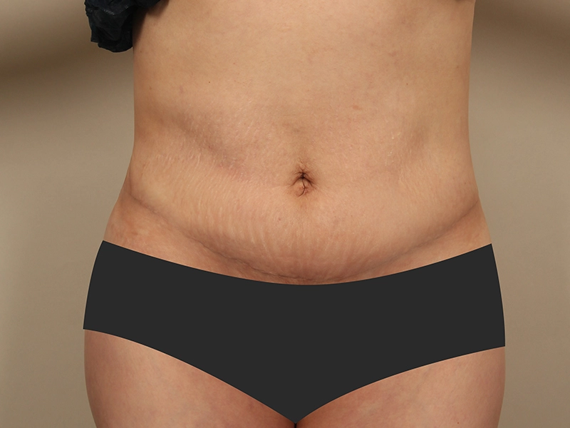 腹部形成術 術後