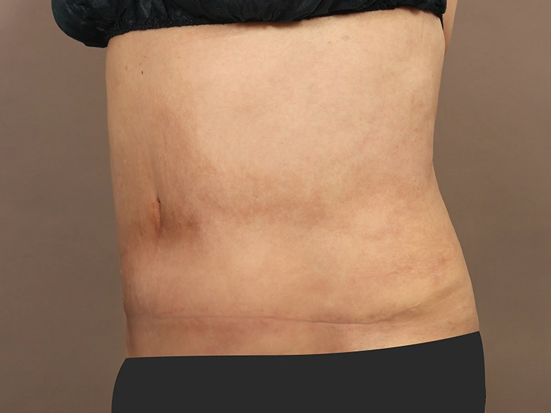 腹部形成術 術後