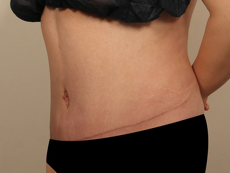 腹部形成術 術後