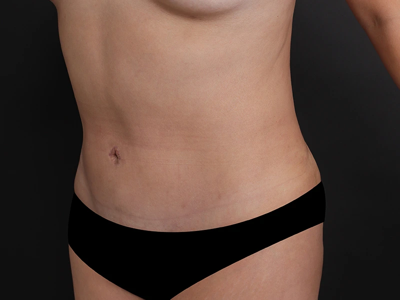 腹部形成術 術後