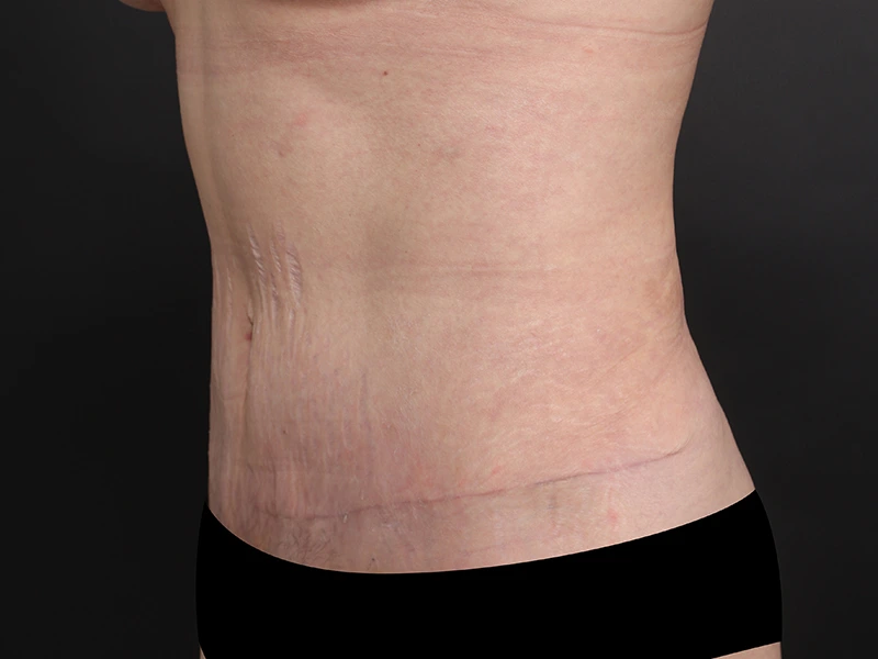 腹部形成術 術後