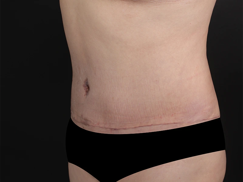 腹部形成術 術後