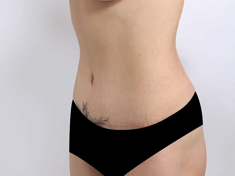 腹部形成術 術後