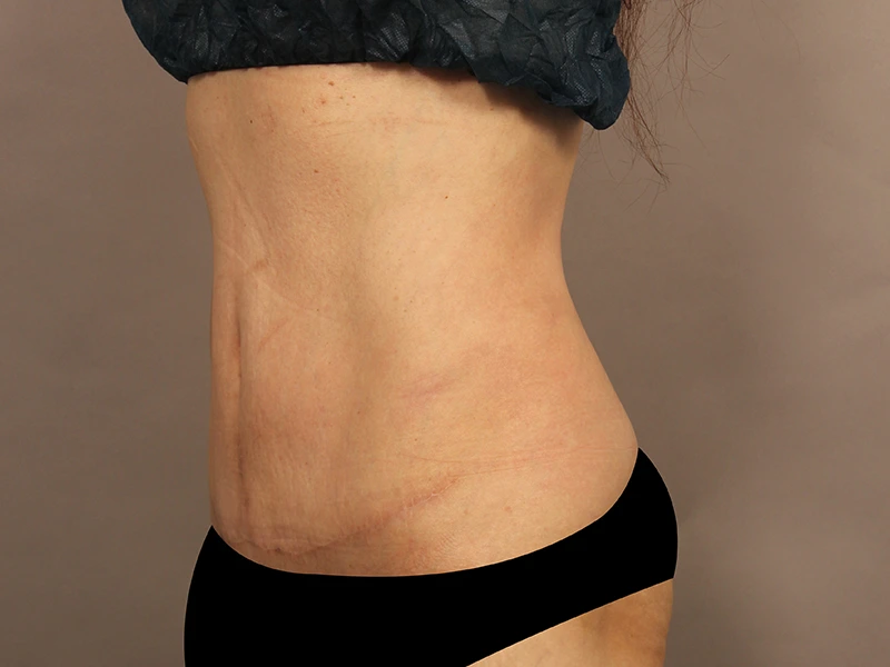 腹部形成術 術後