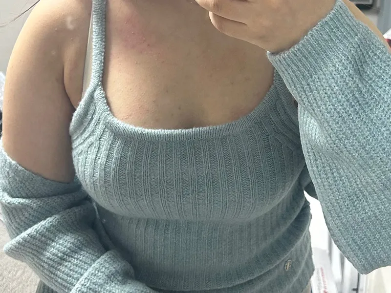 バスト脂肪注入 術後