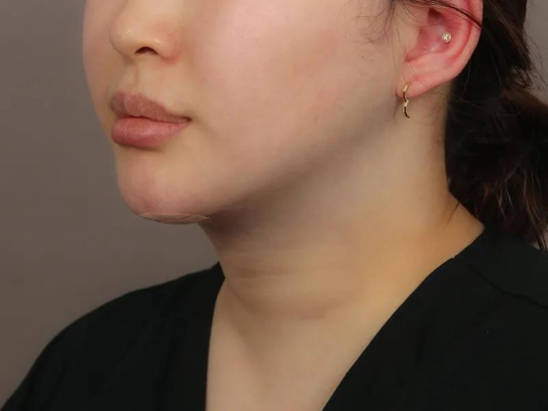 顔部脂肪吸引 術後