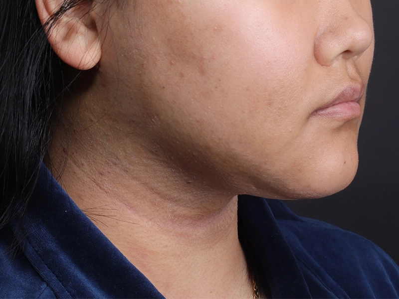 顔部脂肪吸引 術後