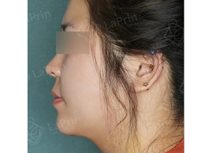 顔部脂肪吸引 術後