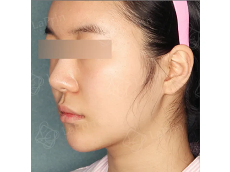 顔部脂肪吸引 術後