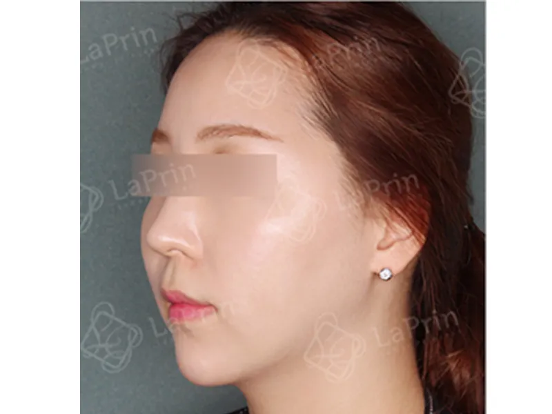 顔部脂肪吸引 術後