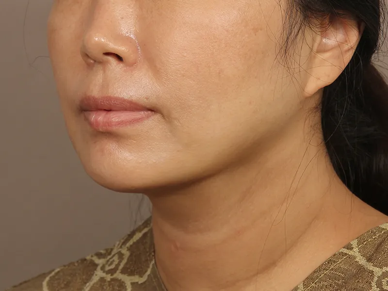 顔部脂肪吸引 術後