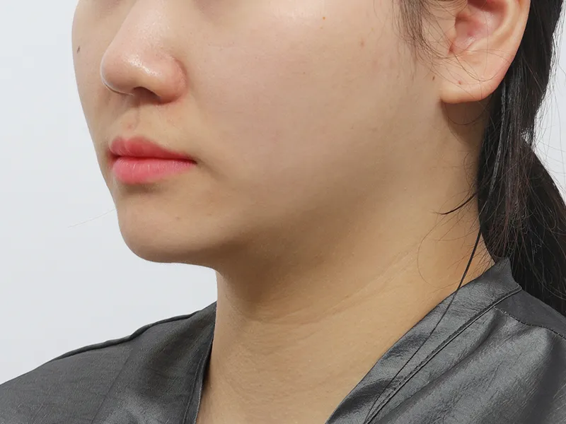 After Facial Liposuction