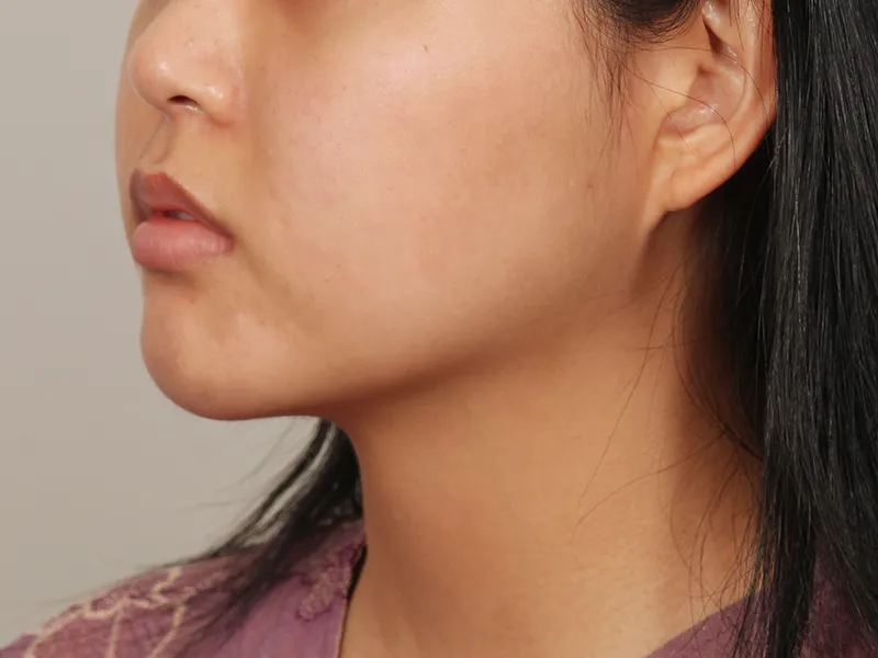 After Facial Liposuction