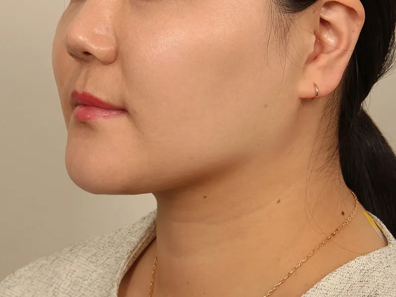 顔部脂肪吸引 術後