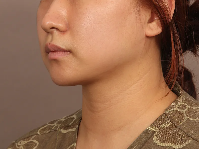 顔部脂肪吸引 術後