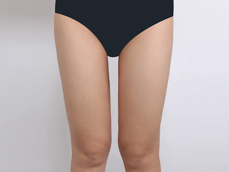 太もも脂肪吸引 術後
