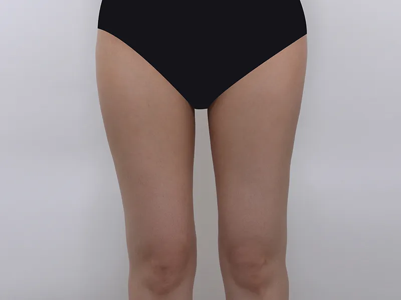 太もも脂肪吸引 術後
