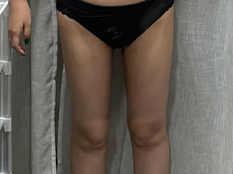 太もも脂肪吸引 術後