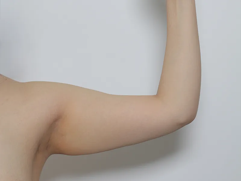 二の腕脂肪吸引 術前