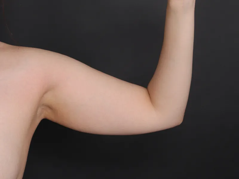 二の腕脂肪吸引 術前