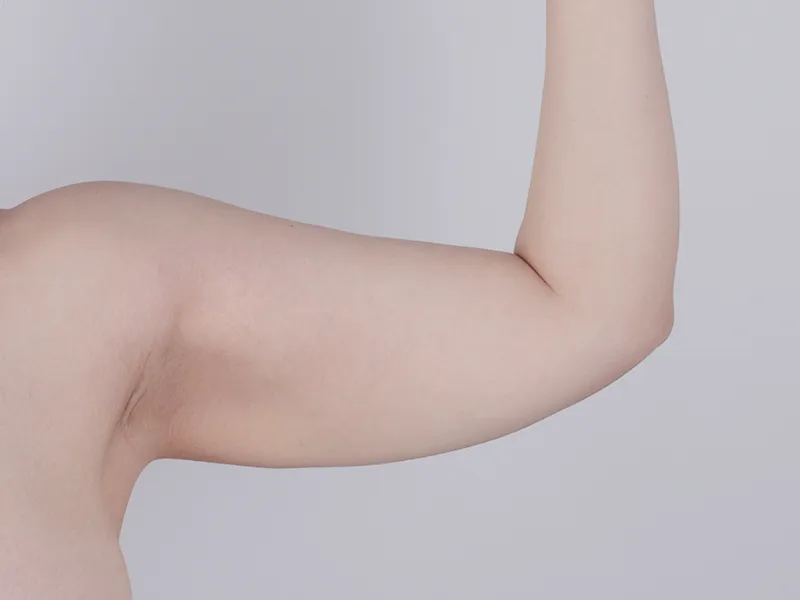 二の腕脂肪吸引 術前