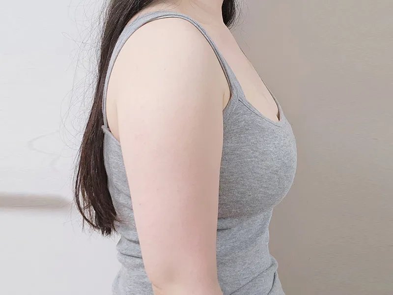 二の腕脂肪吸引 術前