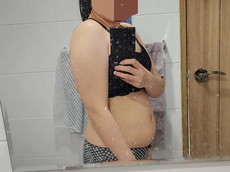 二の腕脂肪吸引 術前