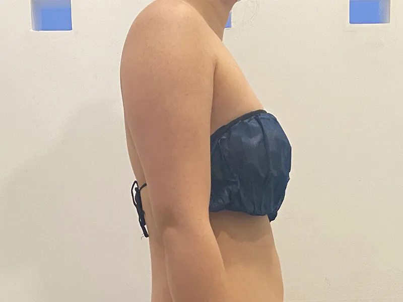 二の腕脂肪吸引 術前