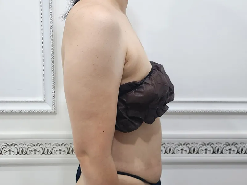 二の腕脂肪吸引 術前