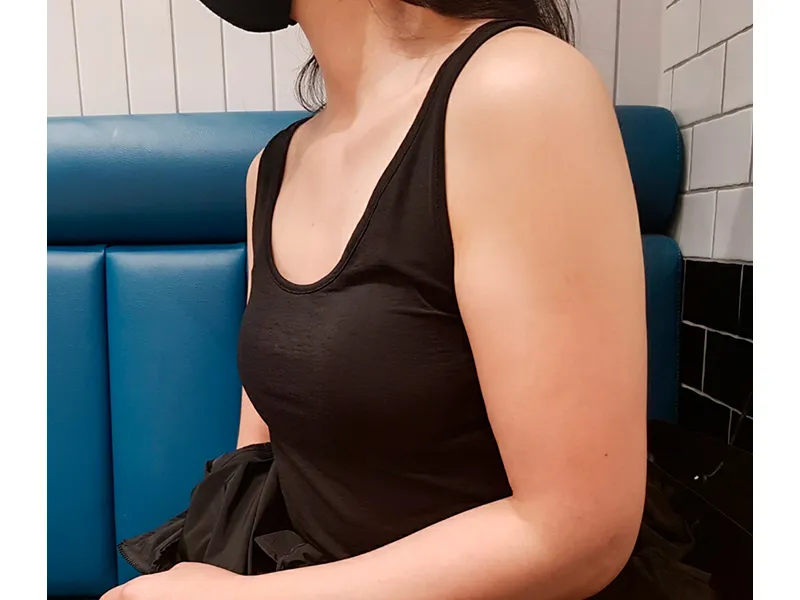 二の腕脂肪吸引 術前