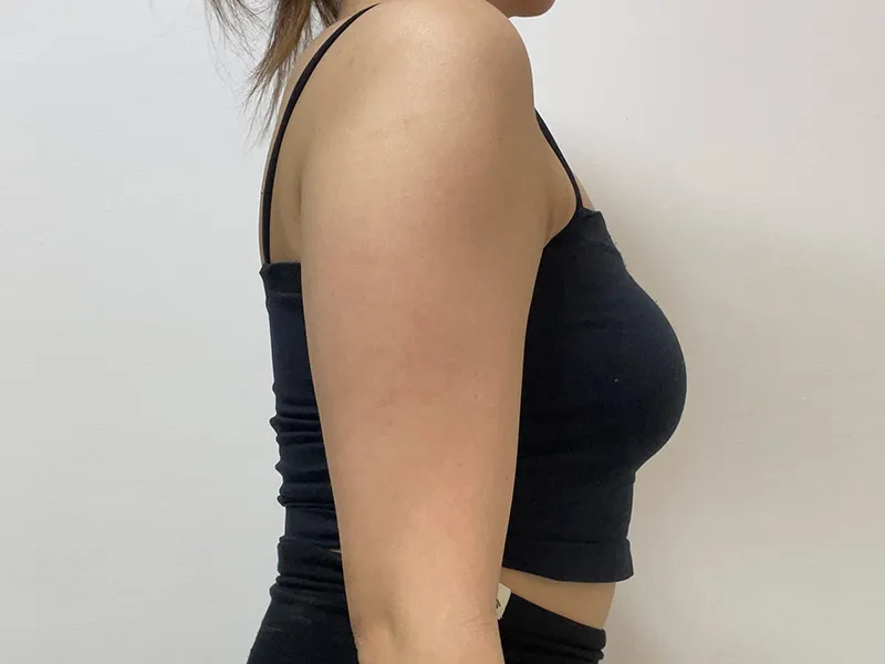 二の腕脂肪吸引 術前