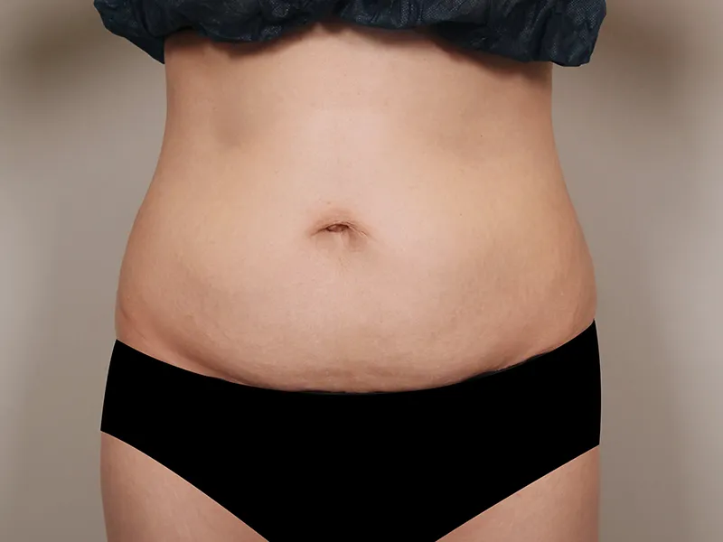 腹部脂肪吸引 術前