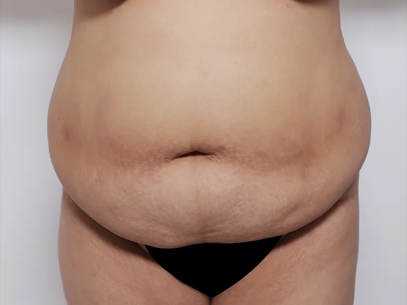 腹部形成術 術前