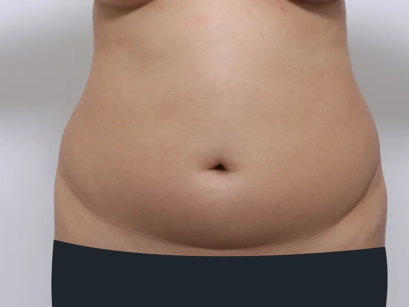 腹部脂肪吸引 術前