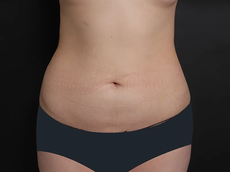 腹部脂肪吸引 術前