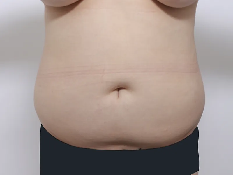 腹部脂肪吸引 術前