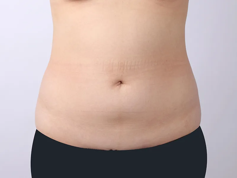 腹部脂肪吸引 術前