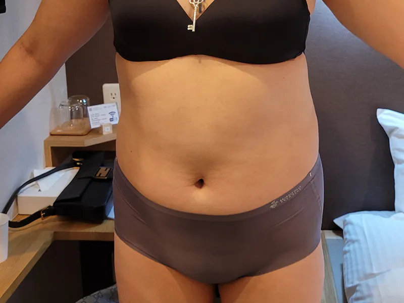 腹部脂肪吸引 術前