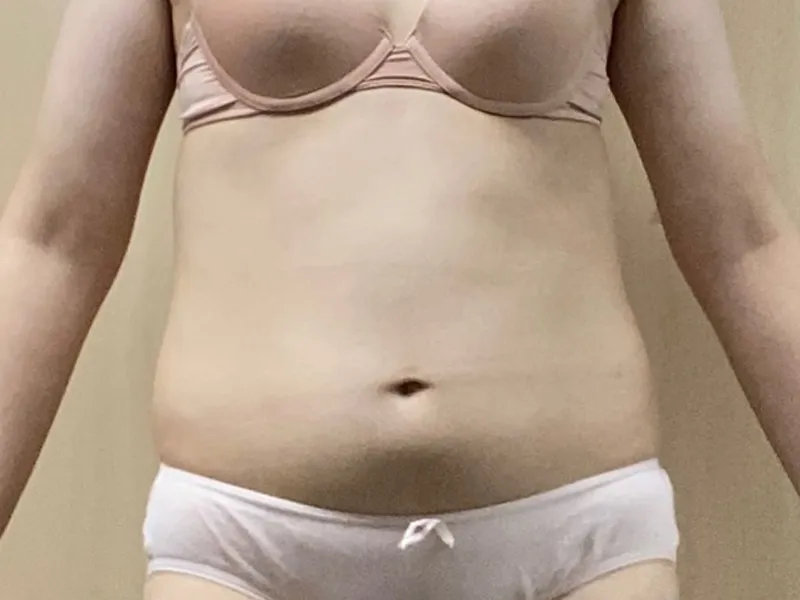 腹部脂肪吸引 術前
