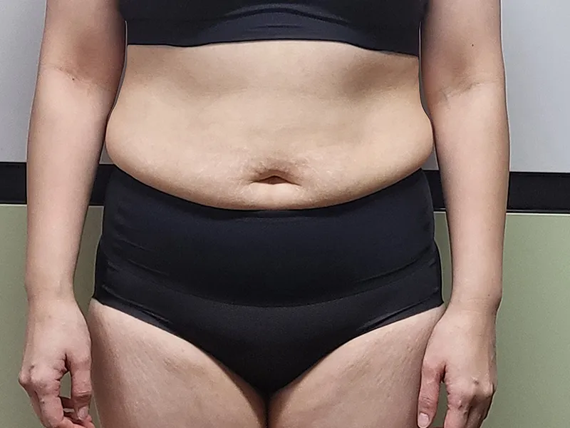 腹部脂肪吸引 術前