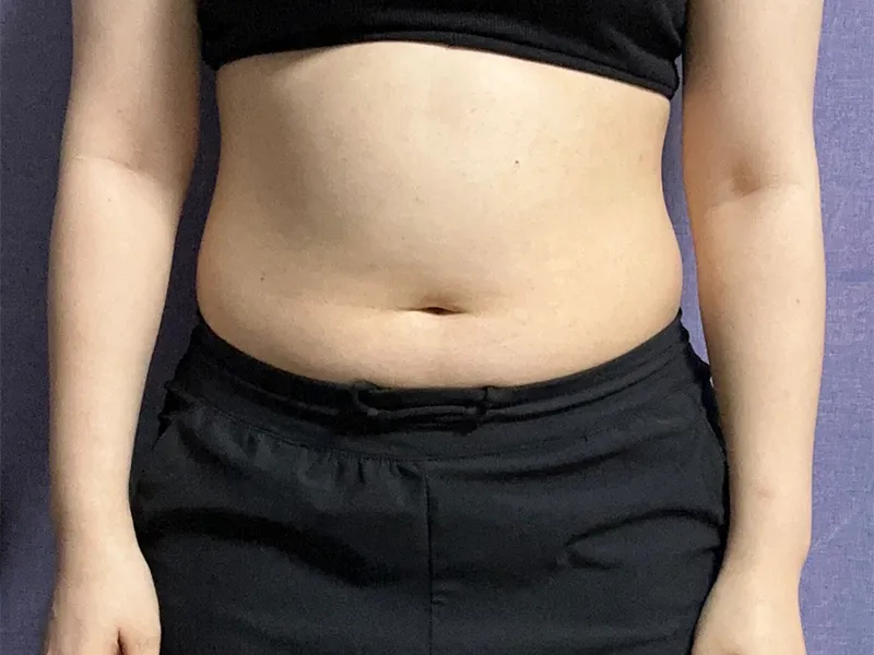 腹部脂肪吸引 術前