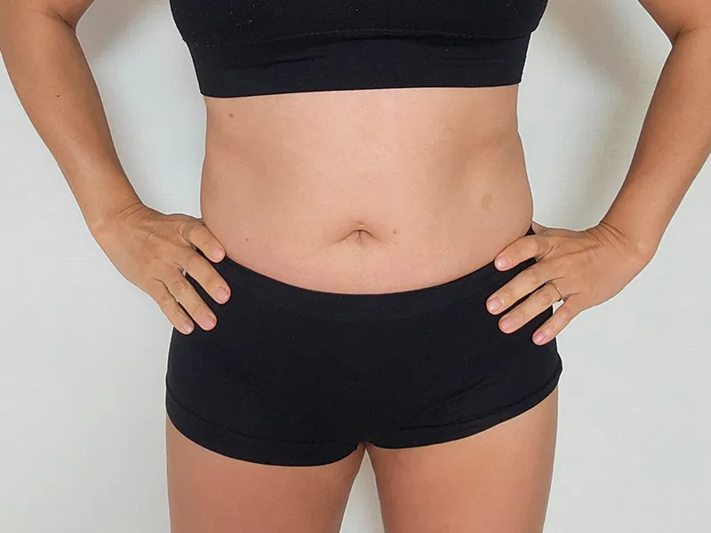 腹部脂肪吸引 術前