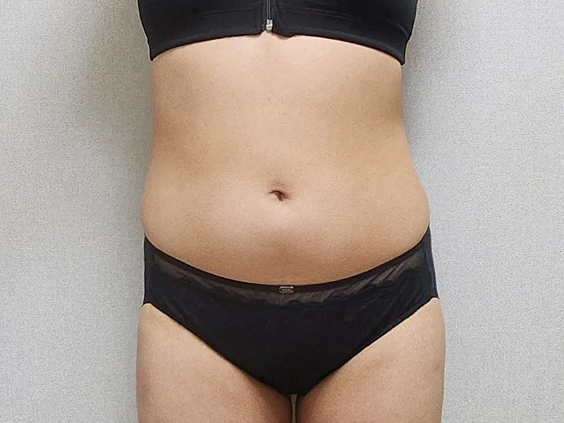 腹部脂肪吸引 術前