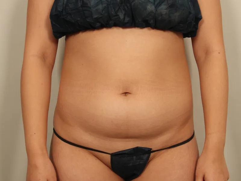 腹部脂肪吸引 術前