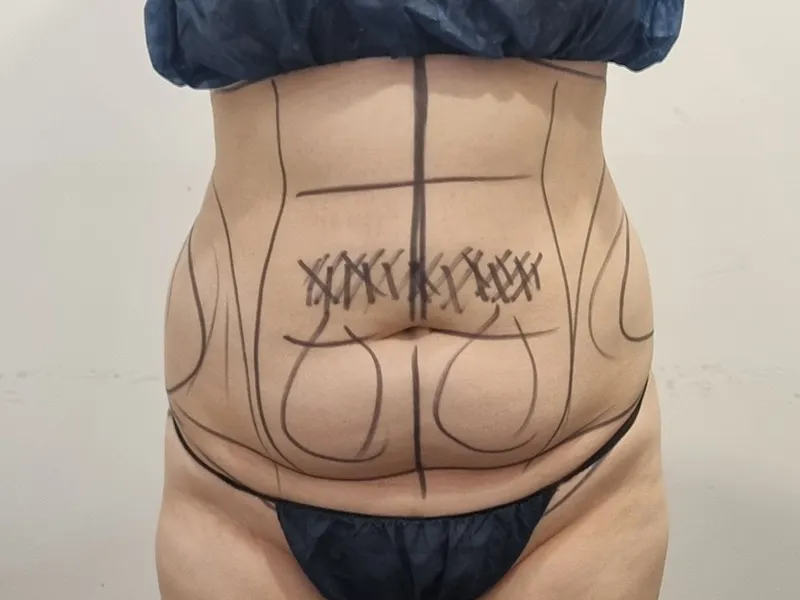 腹部脂肪吸引 術前