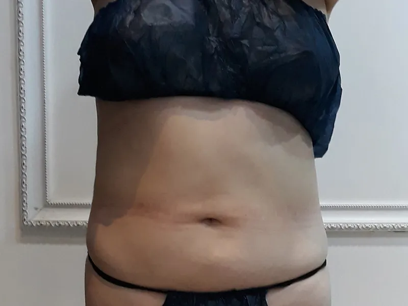 腹部脂肪吸引 術前
