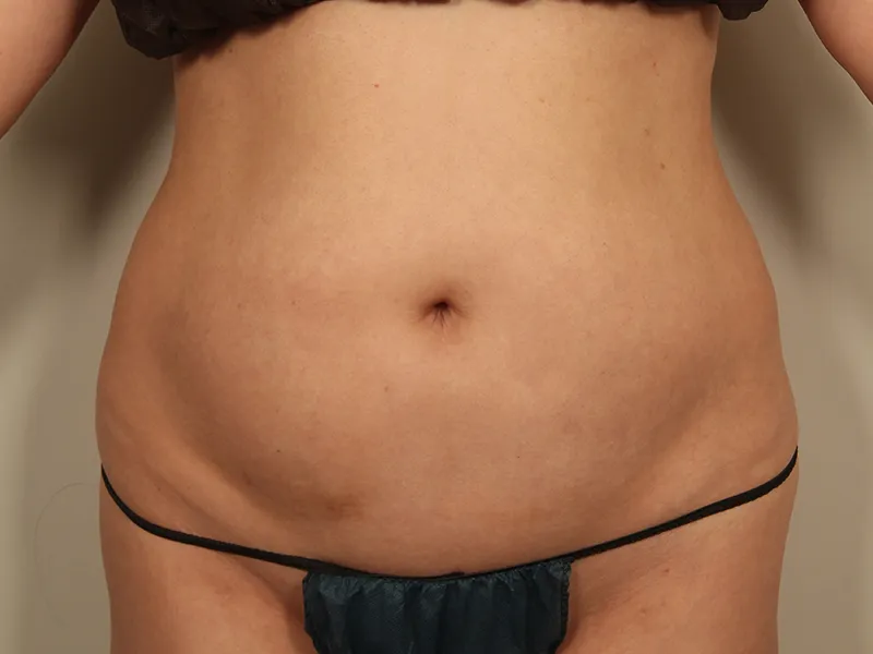 腹部脂肪吸引 術前